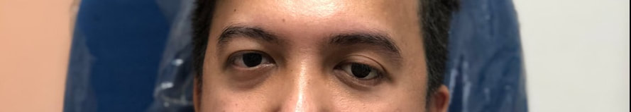 Prosthetic eye in the Philippines