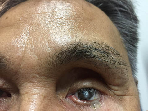 A Patient wearing a rough Artificial Eye with excess Discharge