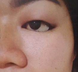 Swollen Eyelid with an Artificial Eye