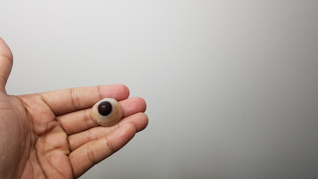 Artificial Eye in the Philippines