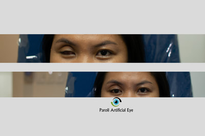 artificial eye in the Philippines