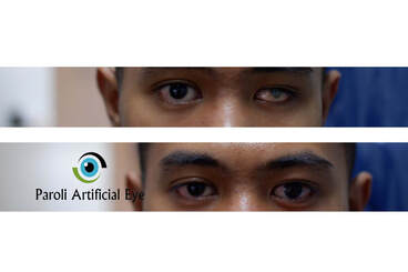 Artificial Eye maker in the Philippines